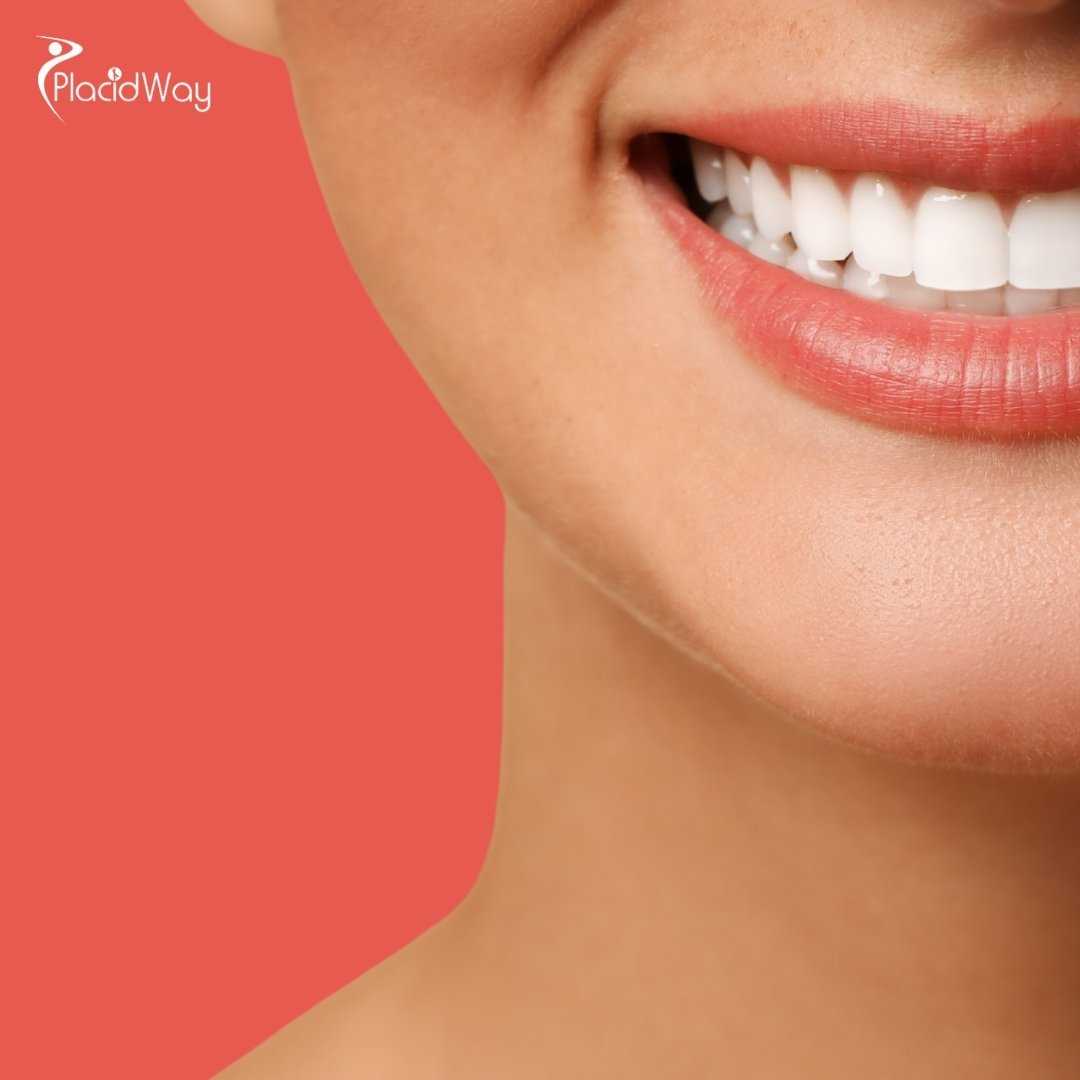 Are Dental Veneers in Mexico Worth It?