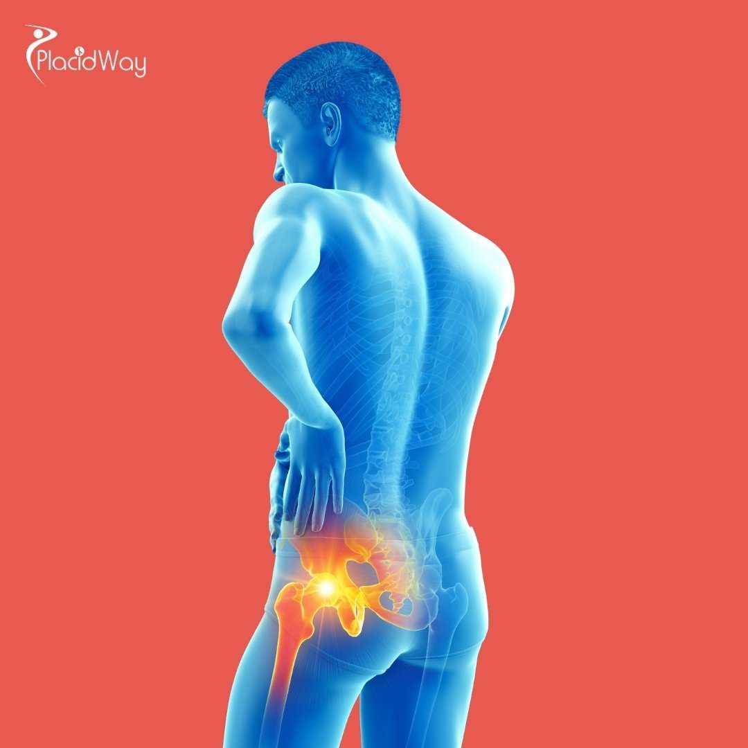 Who Is the Best Orthopedic Surgeon for Hip Replacement in Mexico?