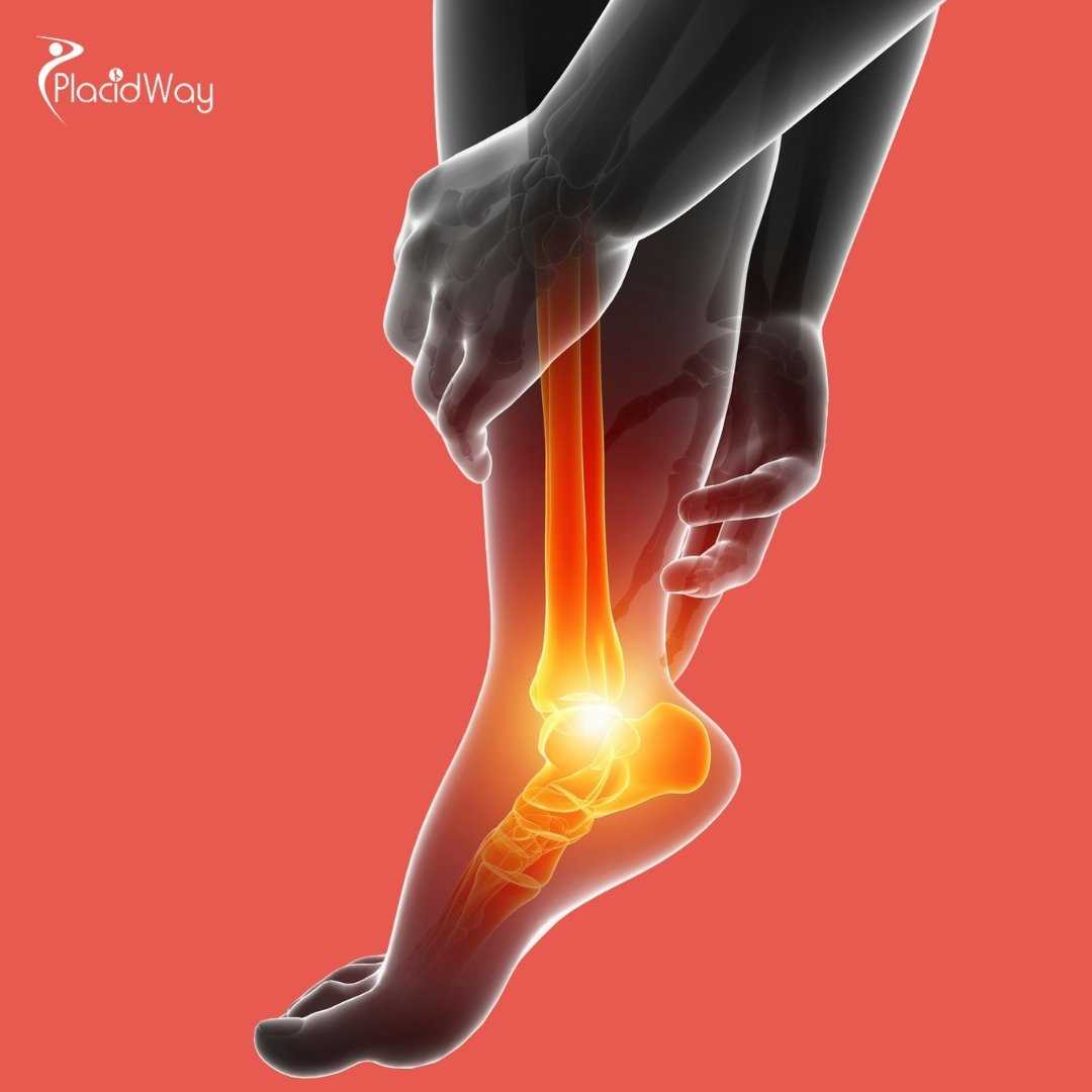 Can Stem Cell Therapy in Mexico Treat Plantar Fasciitis?