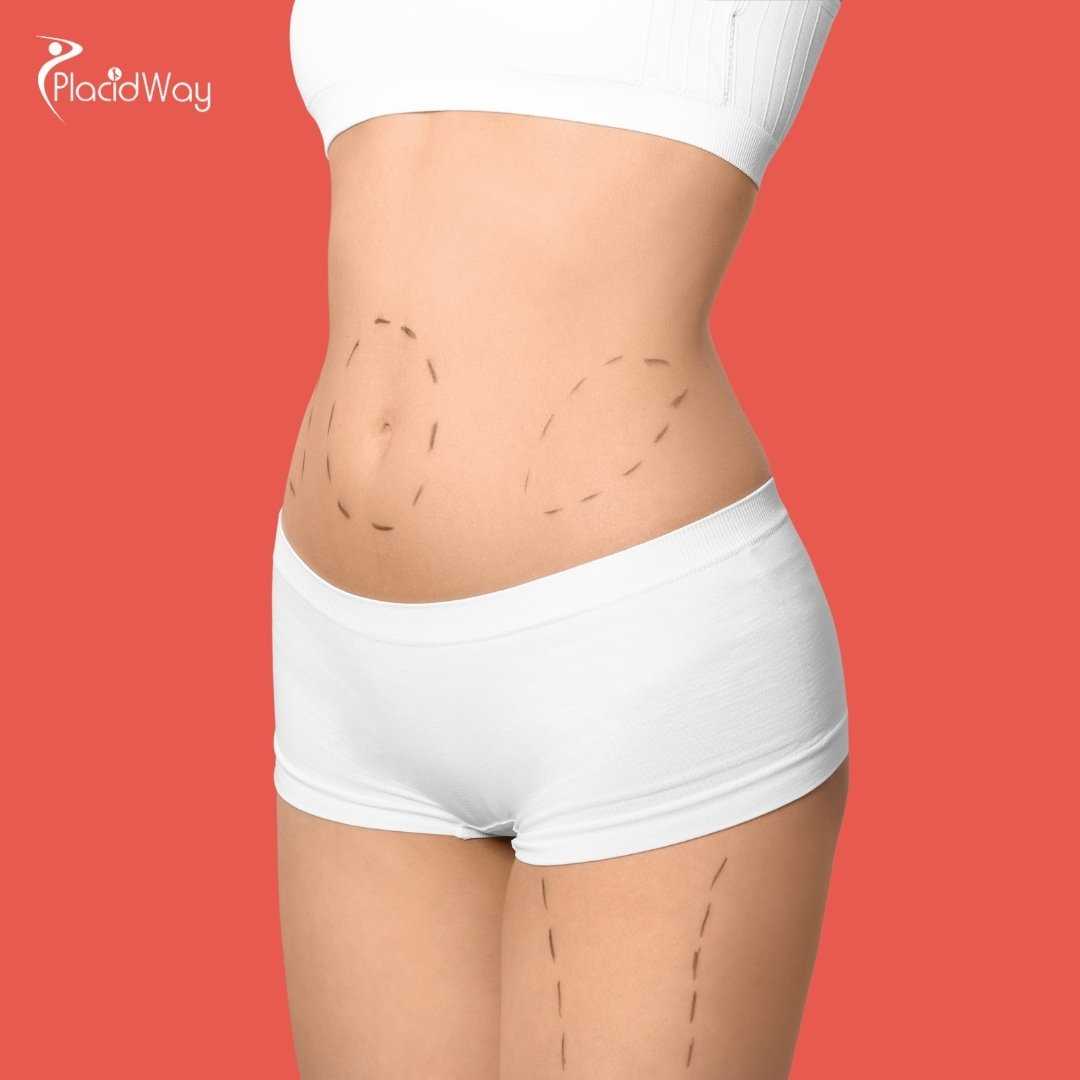 What is the Difference Between Liposuction and Liposculpture in Mexico?