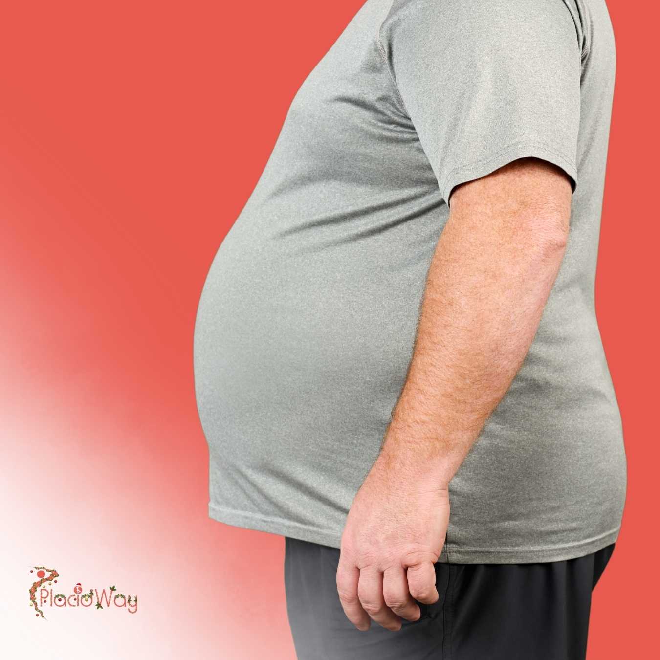 What Are the Qualifications for Roux en Y Gastric Bypass in Mexico?