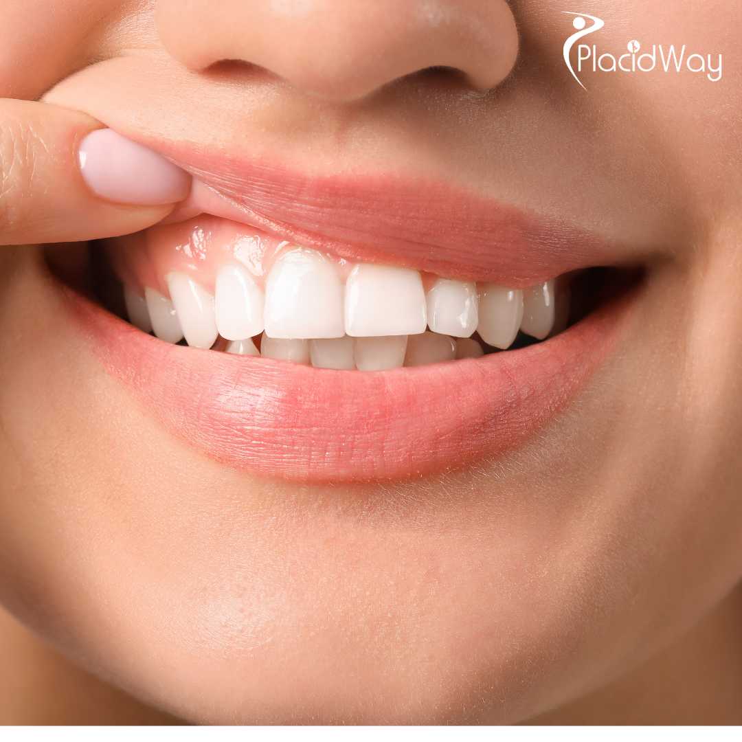 Is Laser Gum Contouring Safe in Korean Clinics?