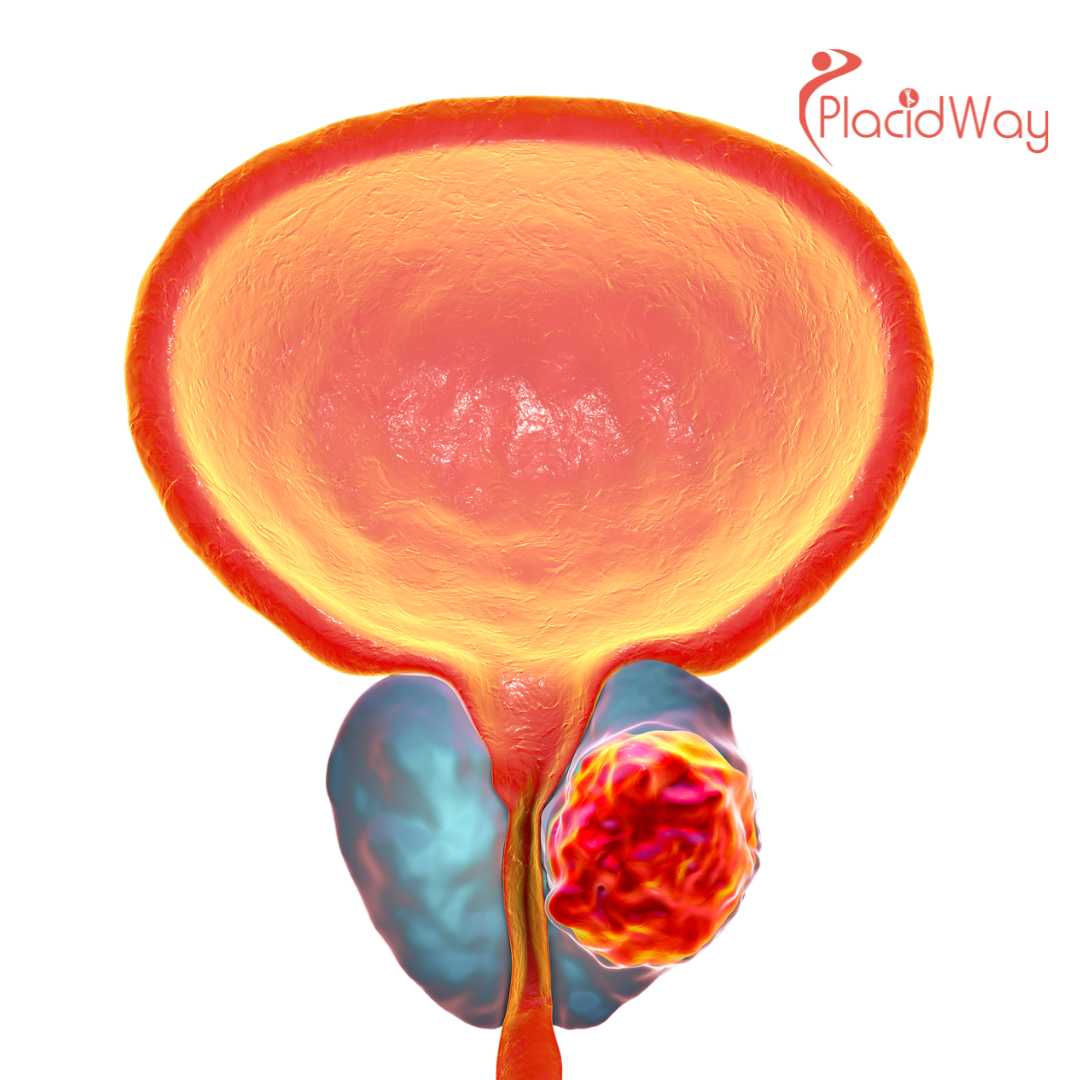 What Success Rates Exist for Colon or Prostate Cancer Immunotherapy in Tijuana, Mexico?