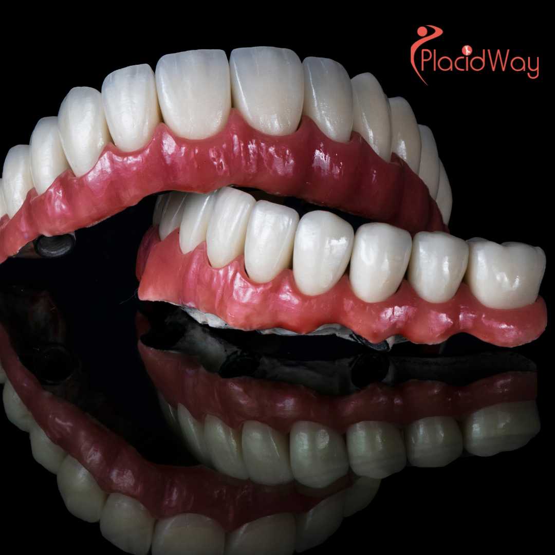 How Much Do All-On-4 or All-On-6 Implants Cost in South Korea?