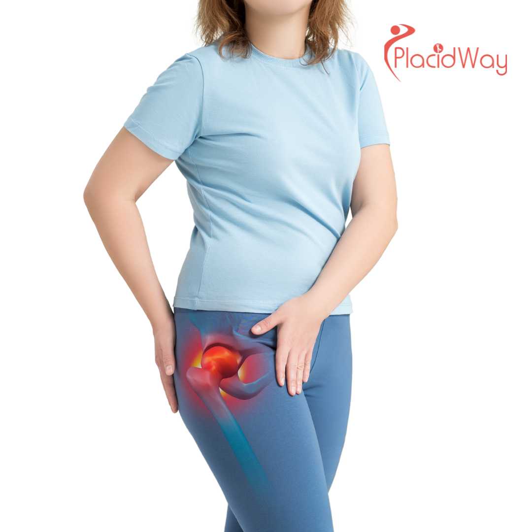 How Much Does Hip Replacement Surgery in India Cost?