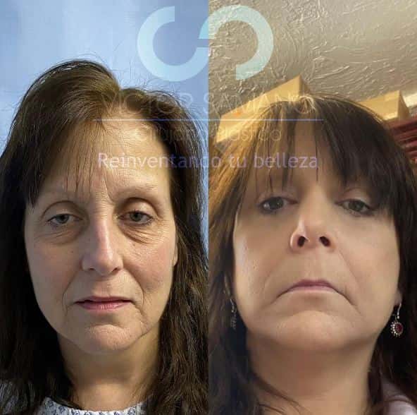 Rinoplastia en cancun antes despues