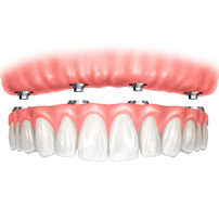 Dentaduras postizas completas en Americas Dental Care Costa Rica
