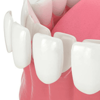 Carillas en Los Algodones, México - Paquete de SANI Dental