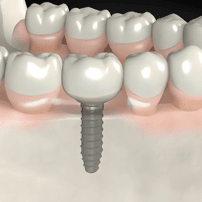 Dental Implants in Los Algodones, Mexico - Package Price $750