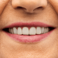 Get Affordable Teeth Whitening Package in Antalya, Turkey