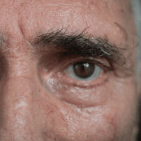 Live Cell Therapy for Retinitis Pigmentosa in Mexico
