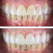 Paquete de empastes y uniones dentales en Nuevo Progreso, México