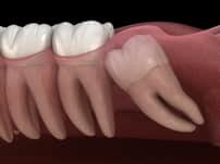 Paquete de extracción de muelas del juicio en Nuevo Progreso, México por Dental Artistry y World Dental Center