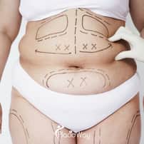 Cheapest Place to get Gastric Balloon Package in Mexico