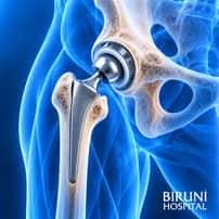 Hip Replacement Surgery Package in Istanbul, Turkey by Biruni Hospital