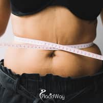 All Inclusive Gastric Sleeve Package in Tijuana, Mexico