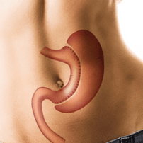 Affordable Gastric Sleeve Surgery Package in Tijuana, Mexico