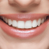 Affordable Full Mouth Implants in Istanbul, Turkey with All-on-4 & All-on-6 Packages