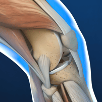 Terapia asequible con células madre para la rodilla en Tijuana, México.