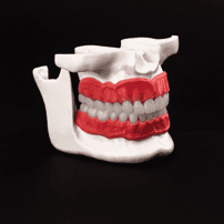Paquete de Implantes Dentales DDS Cinthya García en Los Algodones, México