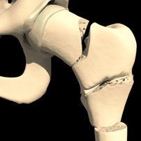 Hip Replacement Surgery Package in Poland
