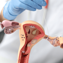 Tubal Ligation Reversal Package in Poland