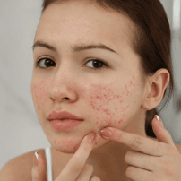 Affordable Stem Cell Mexico City Package for Scar Treatment by Dr. Ary Papadopulos