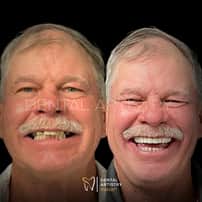 Implantes dentales asequibles de Dental Artistry y World Dental Center en Nuevo Progreso, México