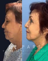 Deep Plane Face Lift Package in Guadalajara, Mexico by PARS