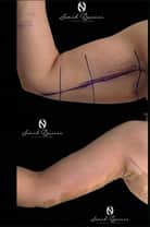 Arm Lift (Brachioplasty Surgery)