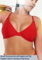 Breast Reconstruction with Implant and Flap Package in Istanbul, Turkey by Turan Turan