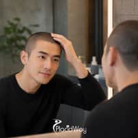 Scalp Micropigmentation Package in Gangnam, South Korea – Hair Density Appearance