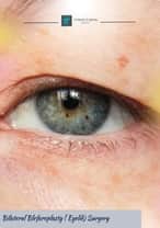 Eyelid Surgery Package in Istanbul, Turkey by Turan Turan