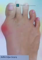 Hallux Valgus / Bunionectomy Surgery with LAPIDUS 3D Technology Package in Istanbul, Turkey by Turan Turan