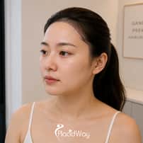 Hairline Lowering Surgery Package in Gangnam, South Korea – Hairline Design