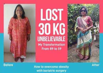 Before After Bariatric Surgery in Gandhinagar, India