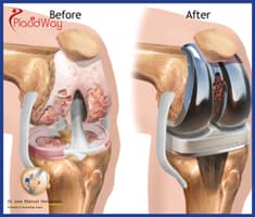 Slider image (6) Dr. Jose Manuel Hernandez - Orthopedic Surgery in Mexico