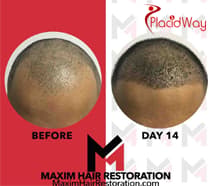 Slider image (2) MAXIM Hair Restoration Turkey