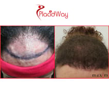 Slider image (3) MAXIM Hair Restoration Turkey