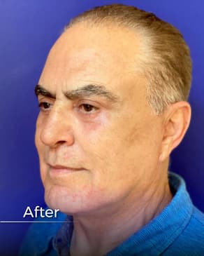 Slider image (7) Boroyan Plastic Surgery in Yerevan Armenia