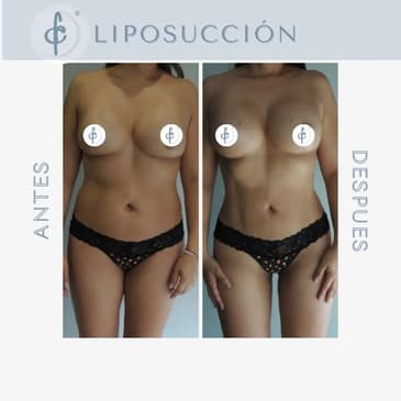 Slider image (4) Dr. Felipe Castro Esguerra - Plastic Surgeon in Colombia
