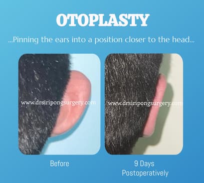 Slider image (5) Dr. Siripong Plastic Surgery in Thailand