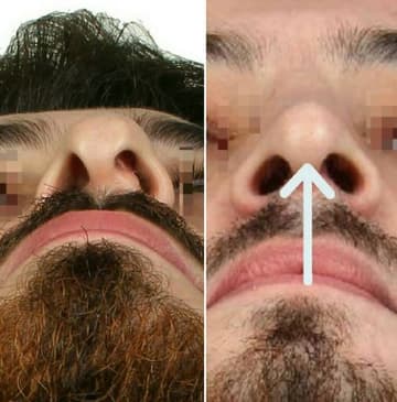 Slider image (5) The Nose Aesthetic Clinic