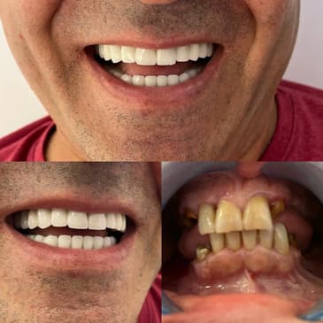 Slider image (9) Zirve Dental