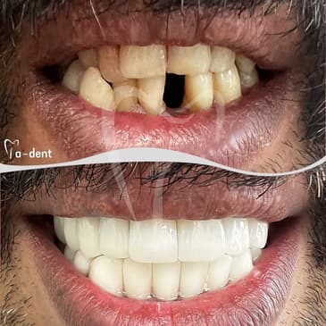 Slider image (7) A-Dent Dental Clinic in Antalya, Turkey