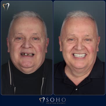 Slider image (1) Soho Dental Clinic – All-on-X & Dental Implant Center