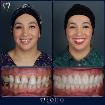Slider image (3) Soho Dental Clinic – All-on-X & Dental Implant Center