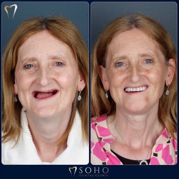 Slider image (4) Soho Dental Clinic – All-on-X & Dental Implant Center