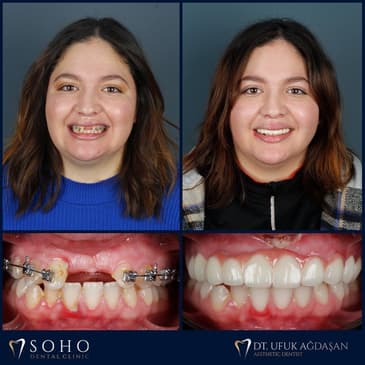Slider image (7) Soho Dental Clinic – All-on-X & Dental Implant Center