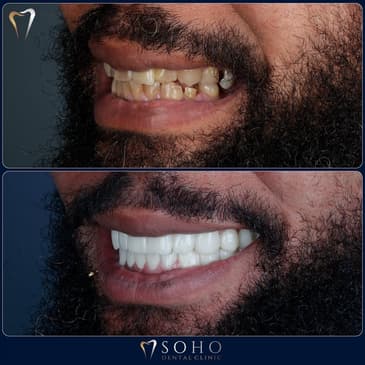 Slider image (9) Soho Dental Clinic – All-on-X & Dental Implant Center